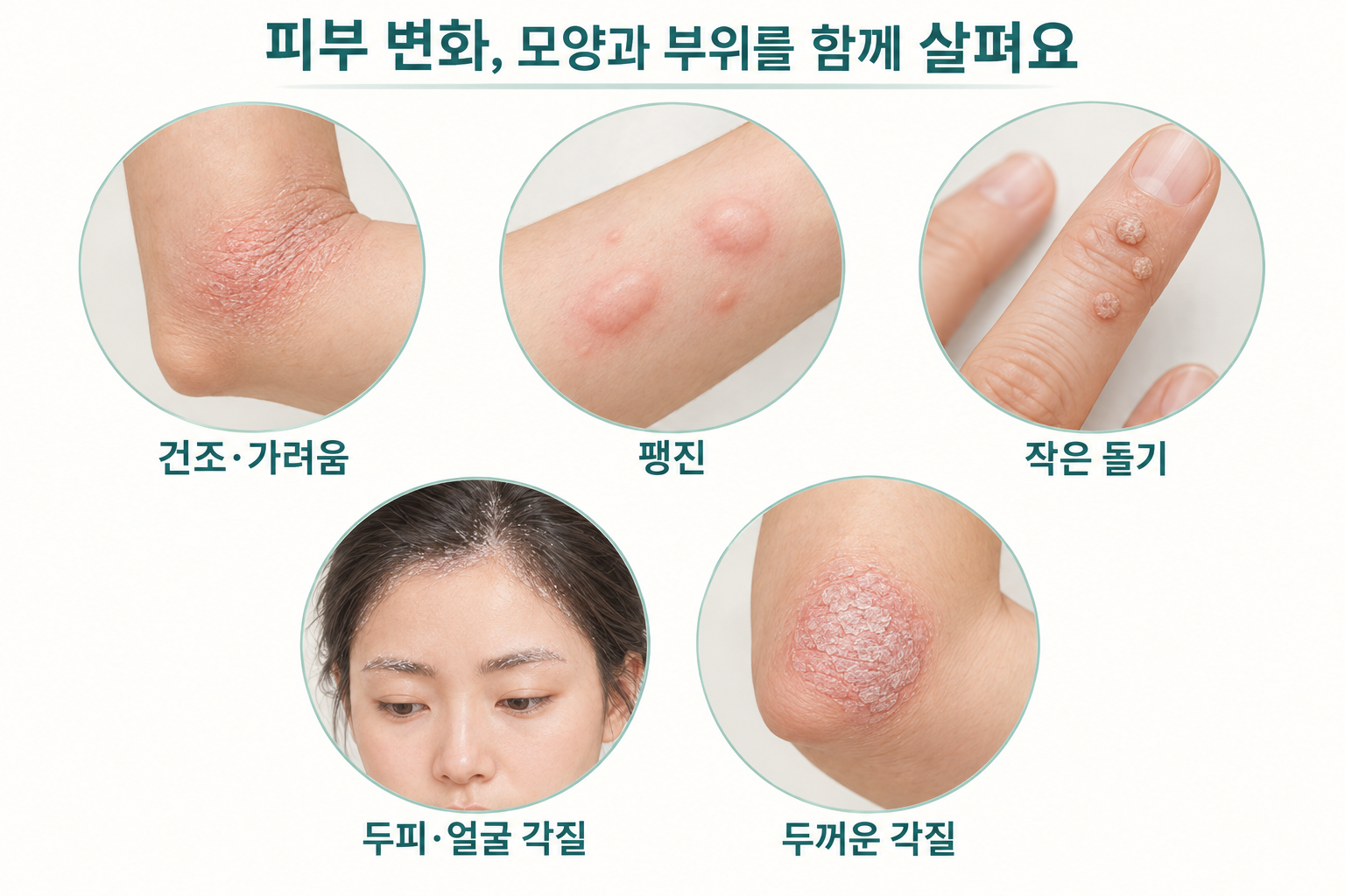 건조와 가려움, 팽진, 작은 돌기, 두피와 얼굴 각질, 두꺼운 각질을 보여주는 피부 변화 설명도