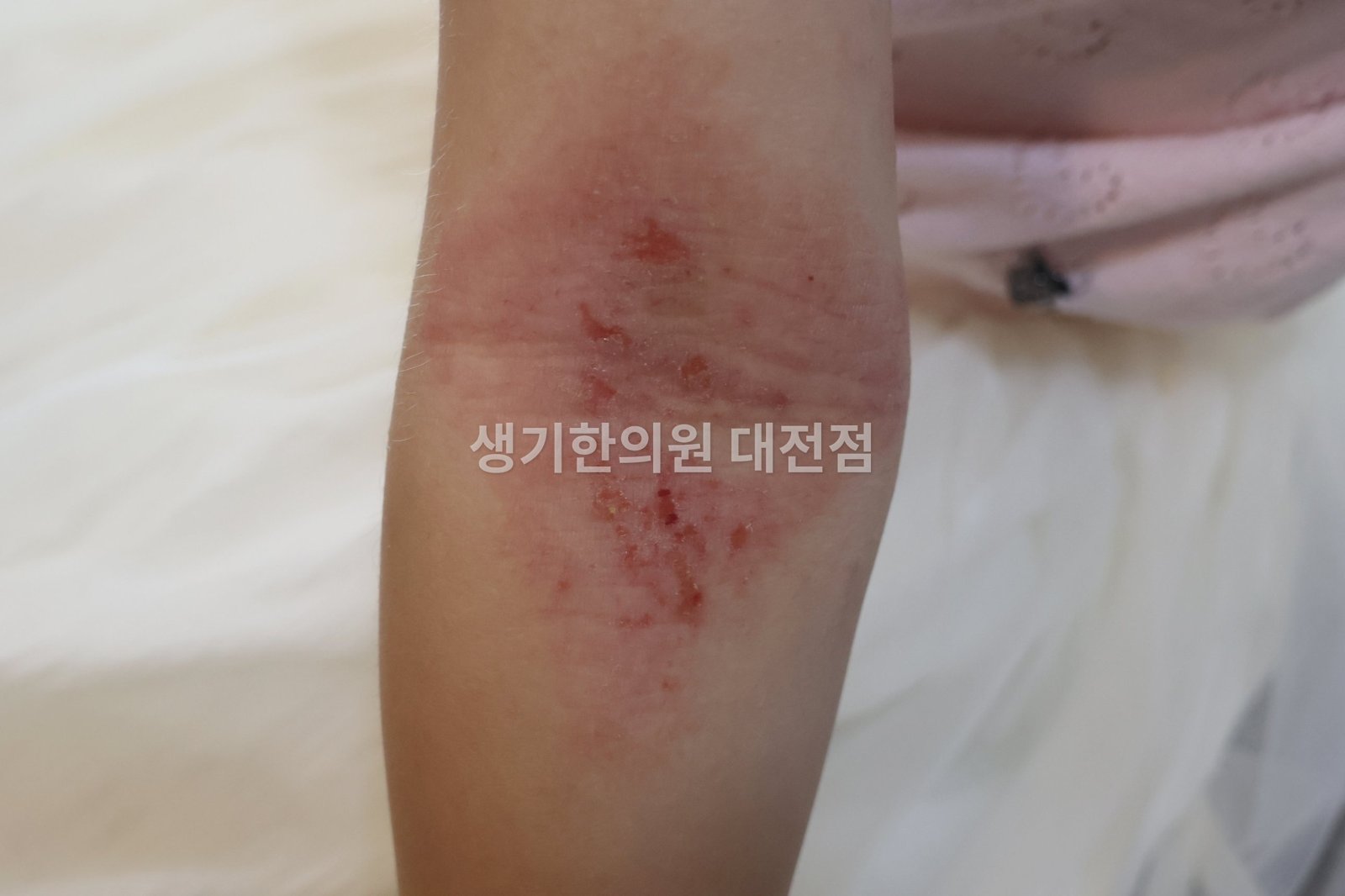 대전 아토피 환자의 팔 안쪽 — 밤사이 긁어 상처와 딱지가 생긴 피부 (치료 전)