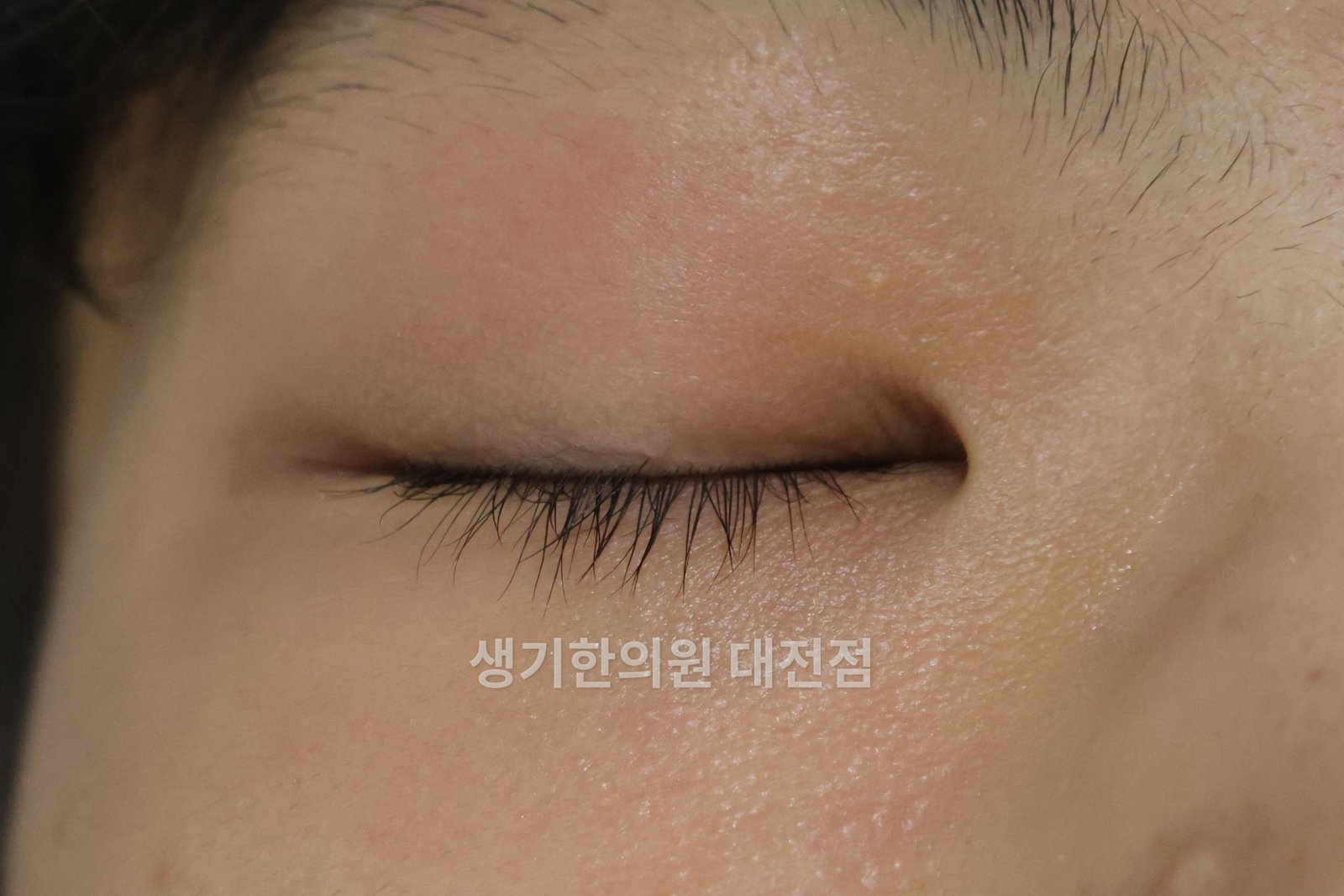 대전 아토피 환자의 눈꺼풀 — 붉게 올라온 얼굴 피부 (치료 전)