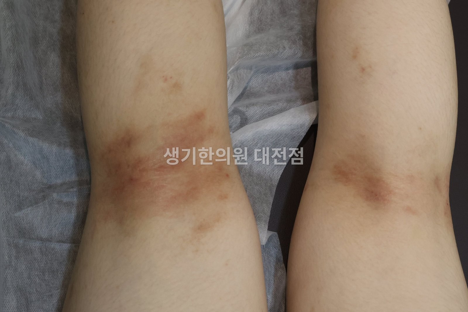대전 아토피 환자의 무릎 뒤 접힐 부위 — 반복해 긁어 색이 진해지고 두꺼워진 피부 (치료 전)