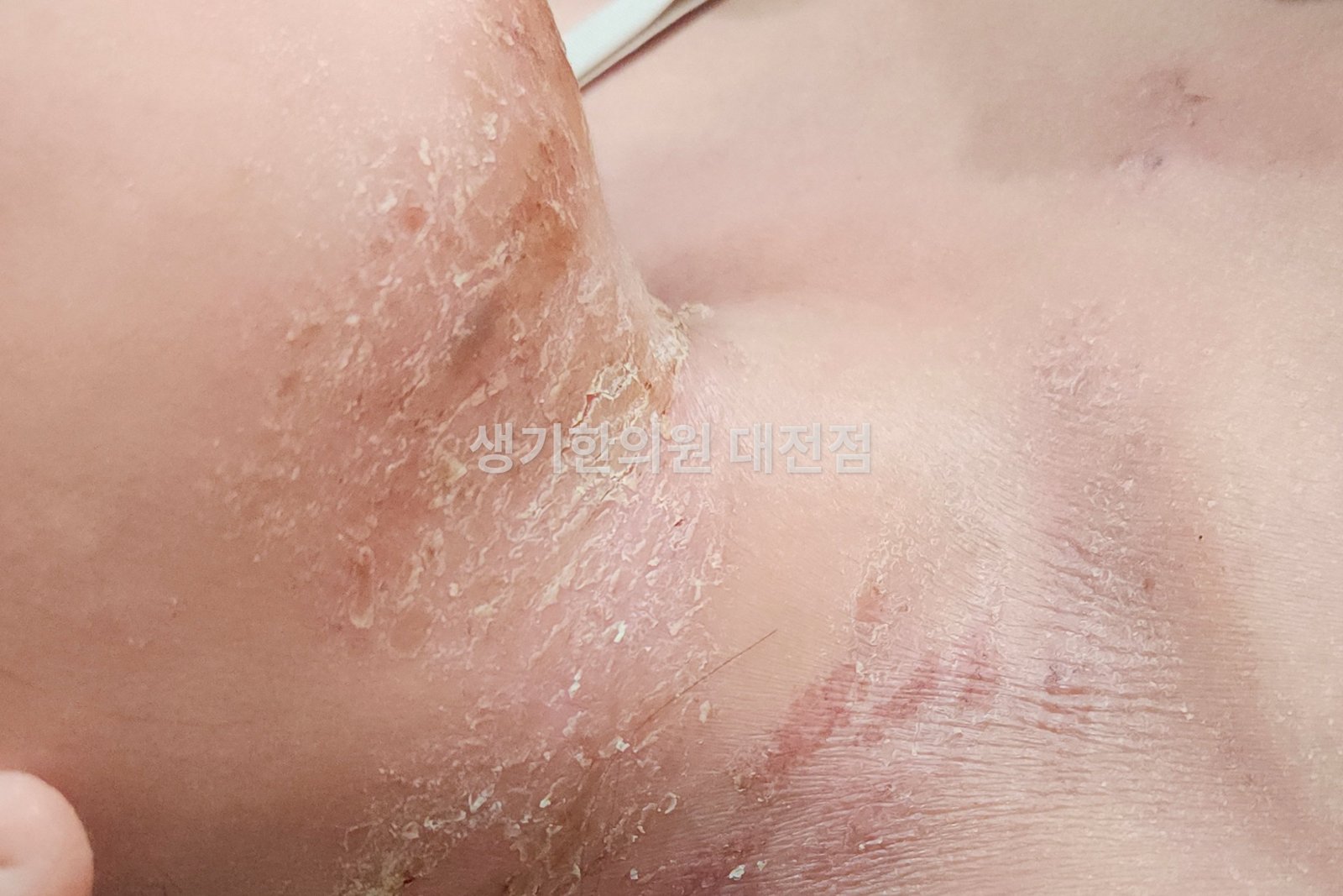 대전 아토피 환자의 목 접힌 부위 — 각질이 일어나고 갈라진 피부 (치료 전)