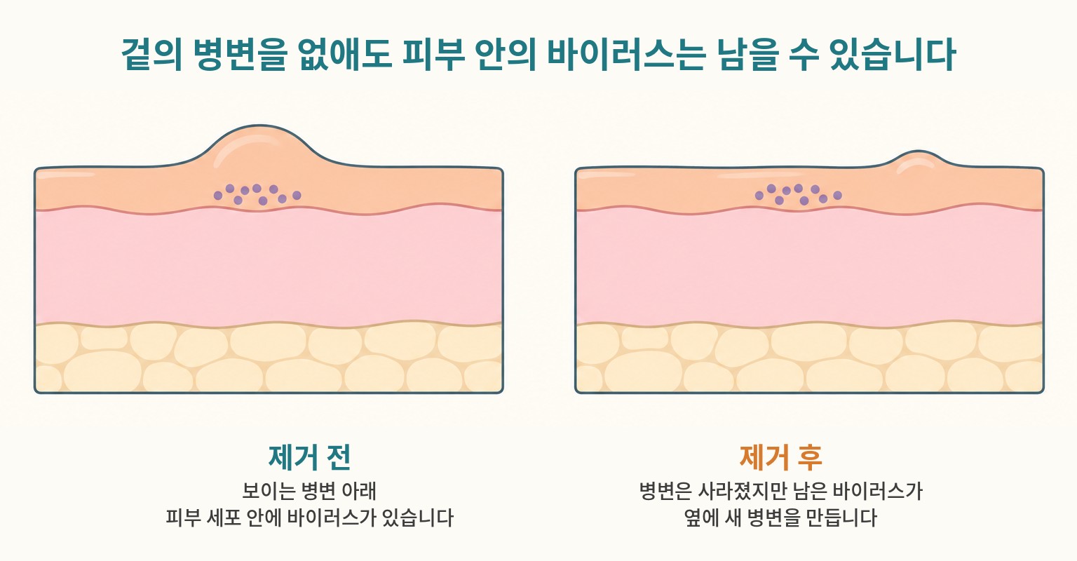 곤지름 피부 단면 도해 · 겉의 병변을 없앤 뒤에도 피부 안에 남은 바이러스가 새 병변을 만드는 과정