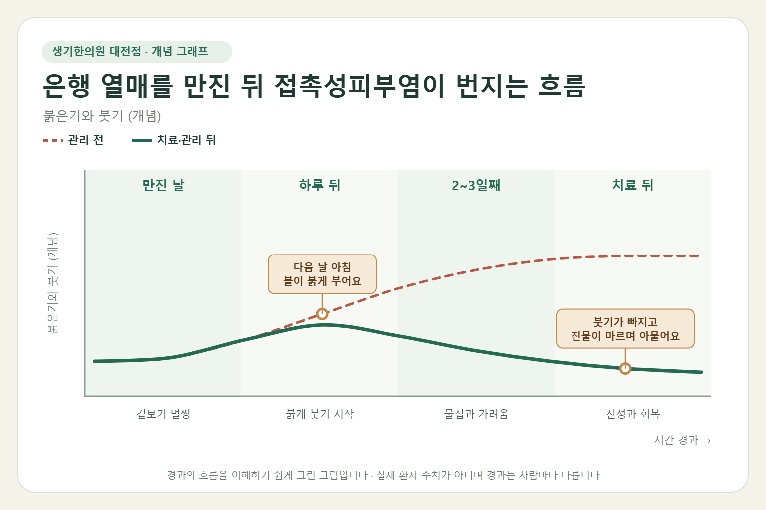 은행 열매를 만진 뒤 접촉성피부염이 번지는 흐름과 치료 뒤 변화를 그린 개념 그래프