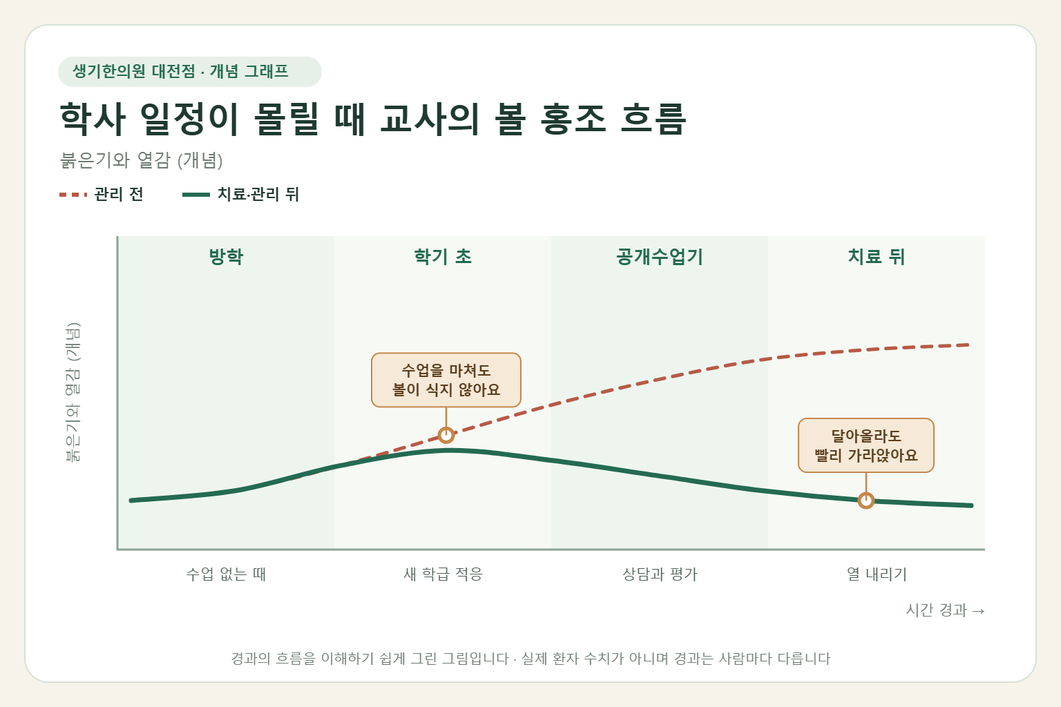 학사 일정이 몰릴 때 교사의 볼 홍조 흐름과 치료 뒤 변화를 그린 개념 그래프