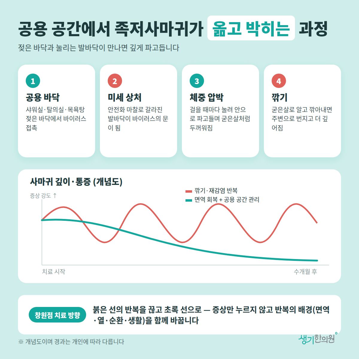 공용 공간에서 족저사마귀가 옮고 박히는 과정 — 공용 바닥, 미세 상처, 체중 압박, 깎기 4가지와 치료 경과 개념 그래프