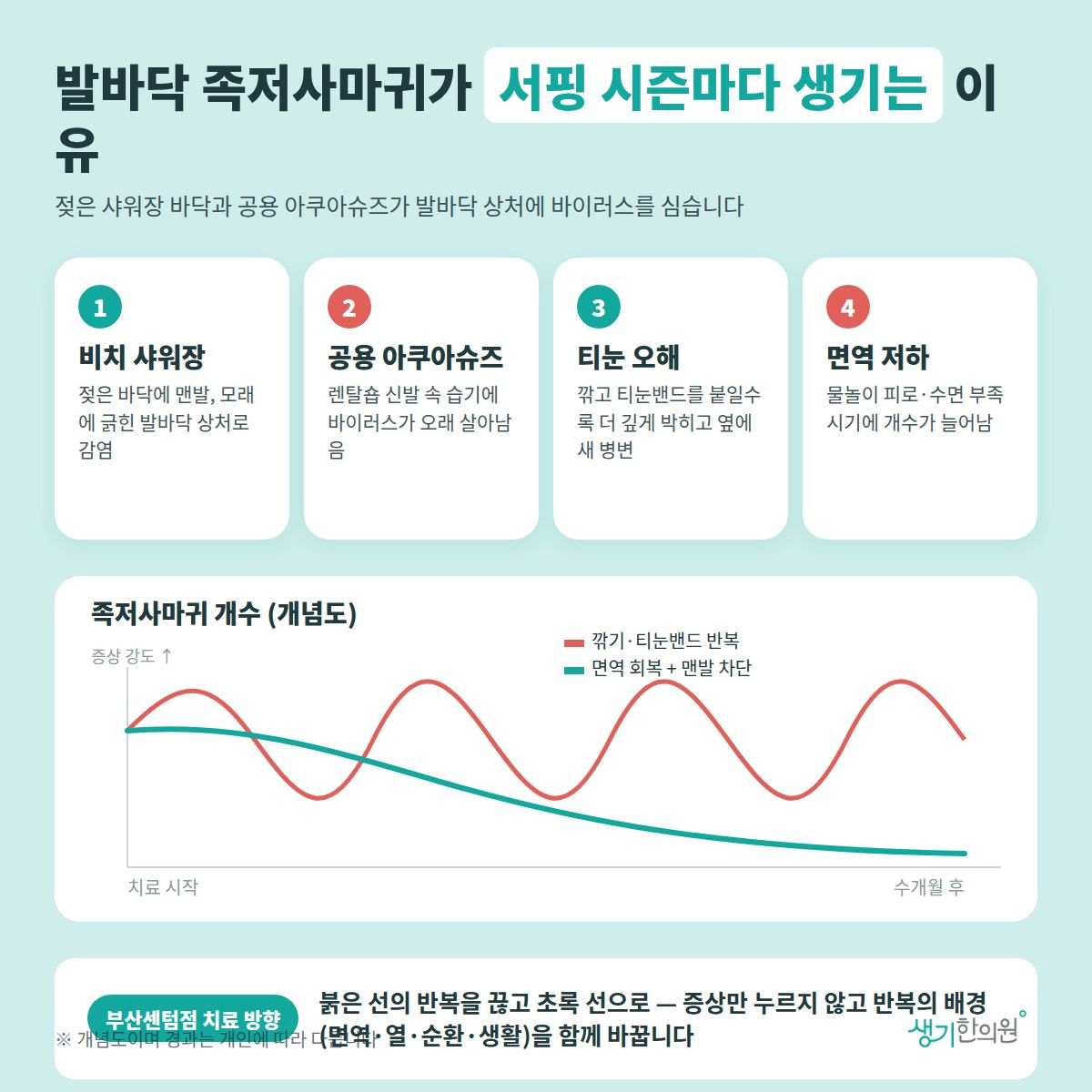 발바닥 족저사마귀가 서핑 시즌마다 생기는 이유 — 비치 샤워장, 공용 아쿠아슈즈, 티눈 오해, 면역 저하 4가지와 치료 경과 개념 그래프