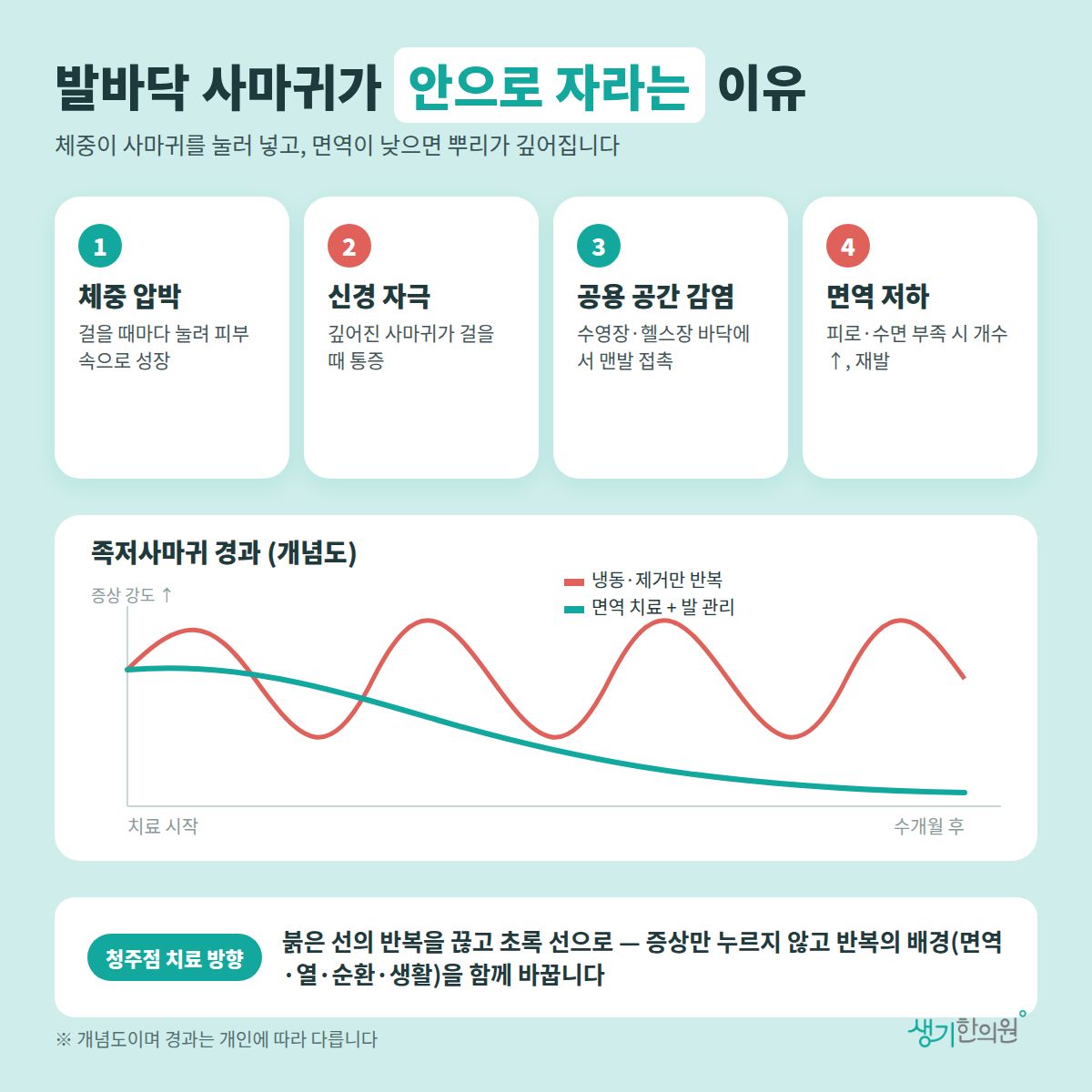 발바닥 사마귀가 안으로 자라는 이유 — 체중 압박, 신경 자극, 공용 공간 감염, 면역 저하 4가지와 치료 경과 개념 그래프