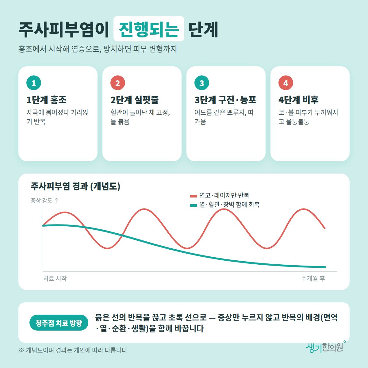 주사피부염이 진행되는 단계 — 1단계 홍조, 2단계 실핏줄, 3단계 구진·농포, 4단계 비후 4가지와 치료 경과 개념 그래프