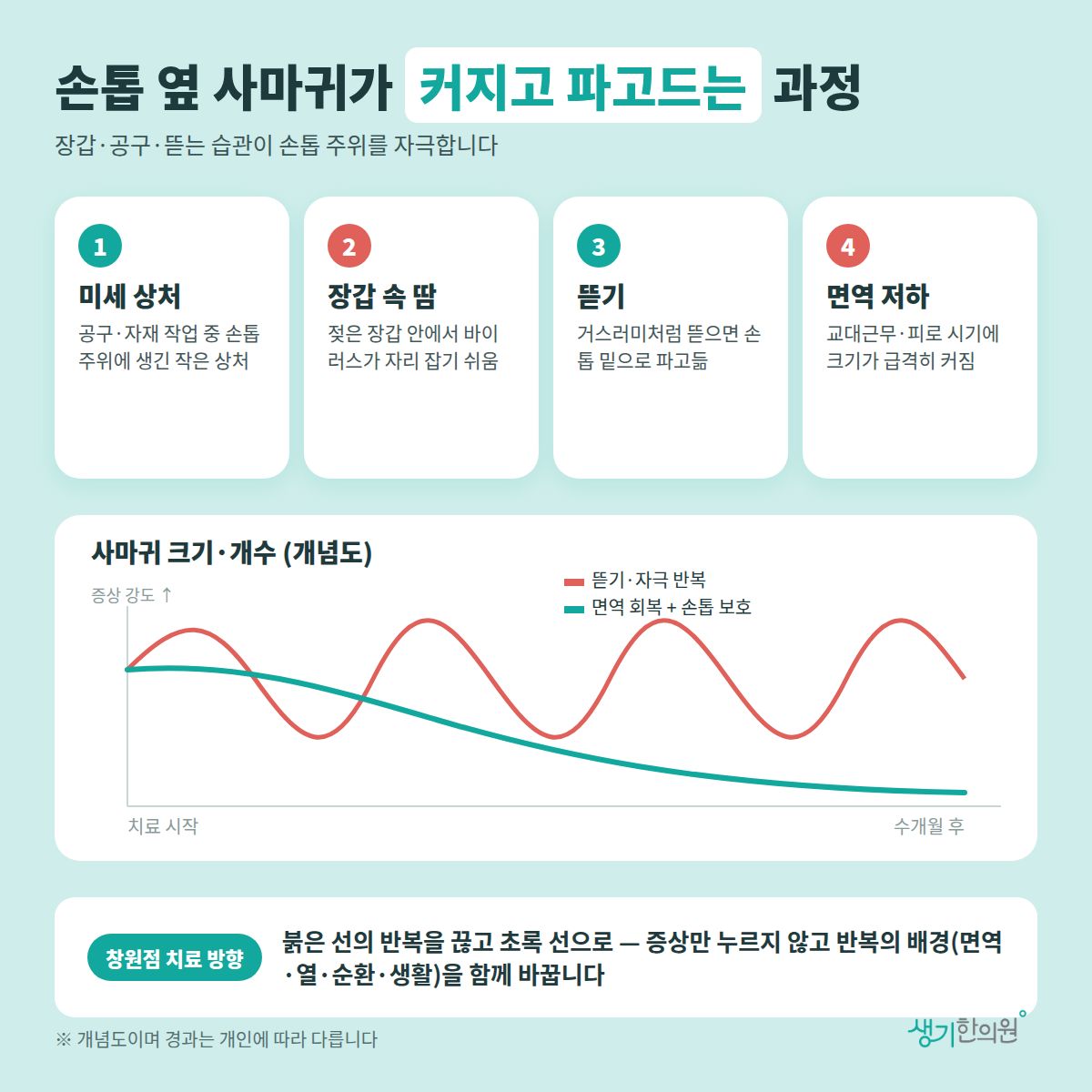 손톱 옆 사마귀가 커지고 파고드는 과정 — 미세 상처, 장갑 속 땀, 뜯기, 면역 저하 4가지와 치료 경과 개념 그래프