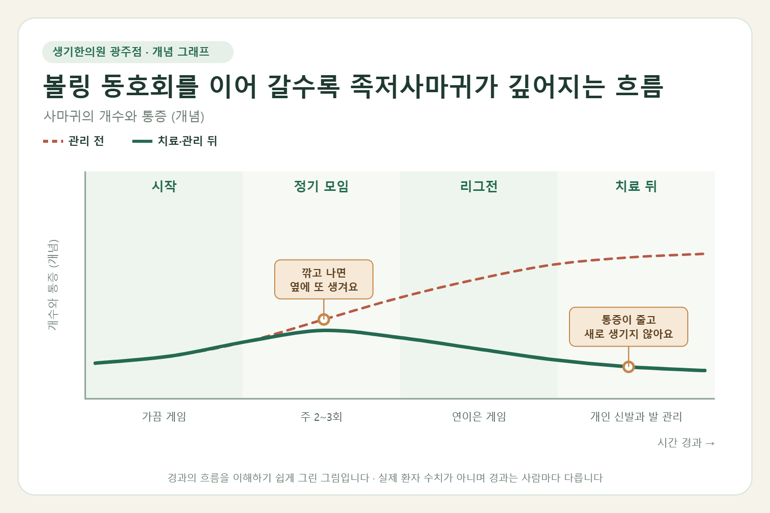 볼링 동호회를 이어 갈수록 족저사마귀가 깊어지는 흐름과 치료 뒤 변화를 그린 개념 그래프