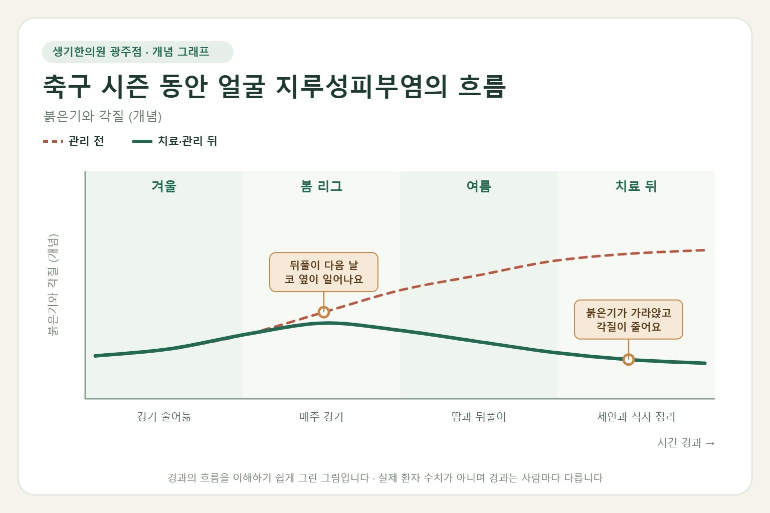 축구 시즌 동안 얼굴 지루성피부염의 흐름과 치료 뒤 변화를 그린 개념 그래프
