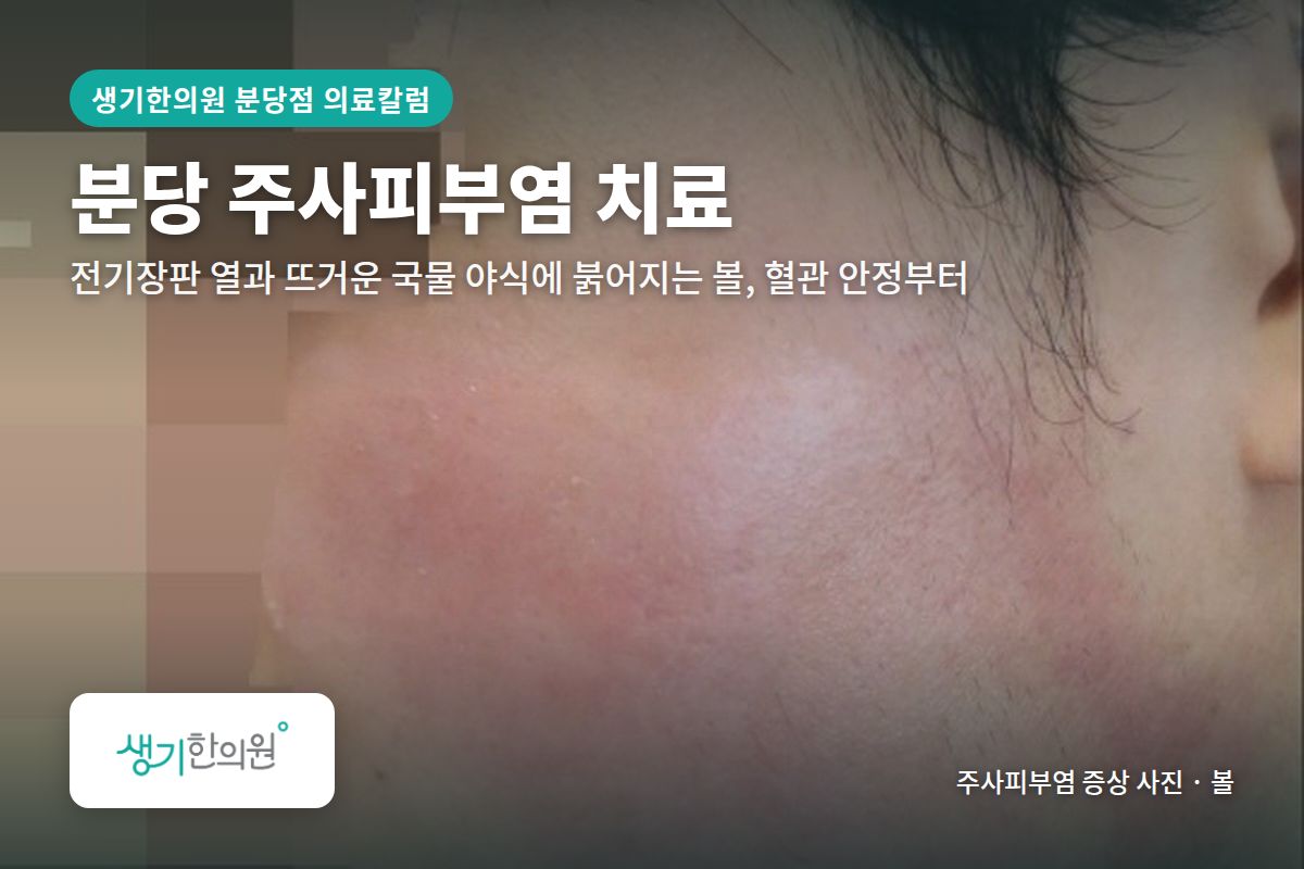 볼 주사피부염 증상 사진과 문구 「분당 주사피부염 치료, 전기장판 열과 뜨거운 국물 야식에 붉어지는 볼, 혈관 안정부터 · 생기한의원 분당점」