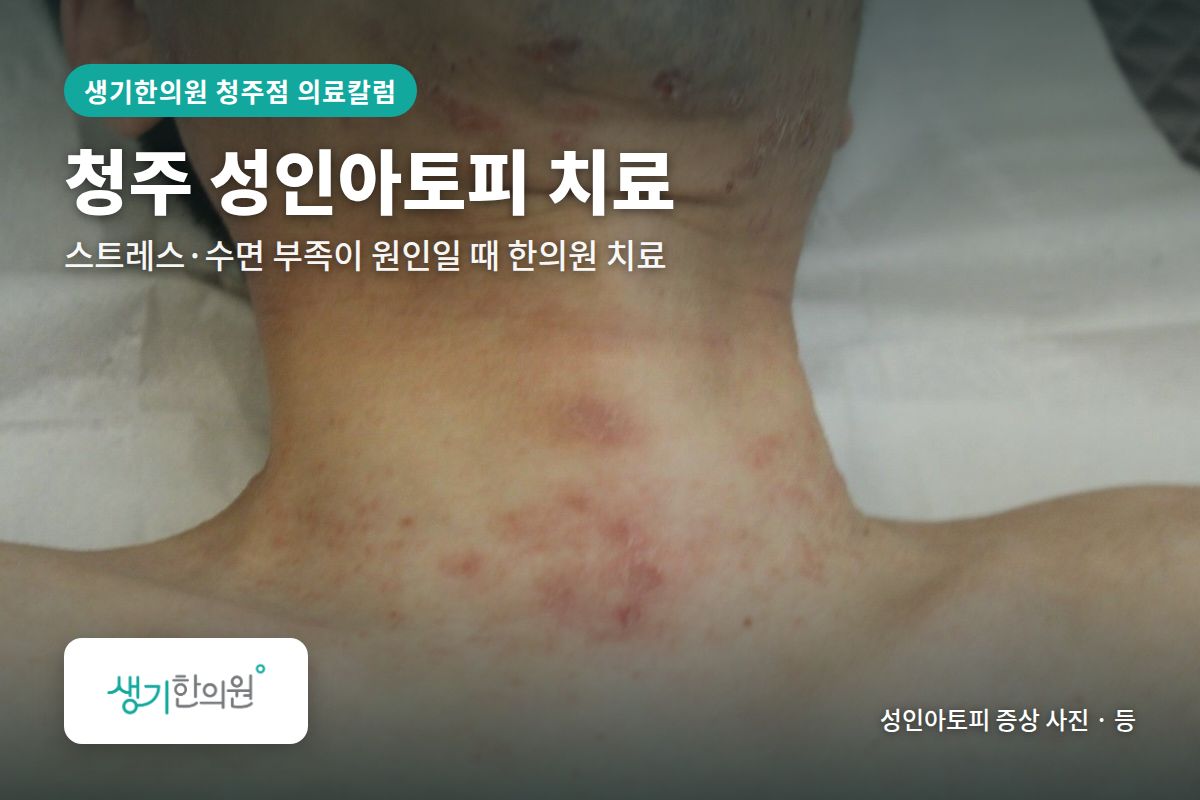 등 성인아토피 증상 사진과 문구 「청주 성인아토피 치료, 스트레스·수면 부족이 원인일 때 한의원 치료 · 생기한의원 청주점」
