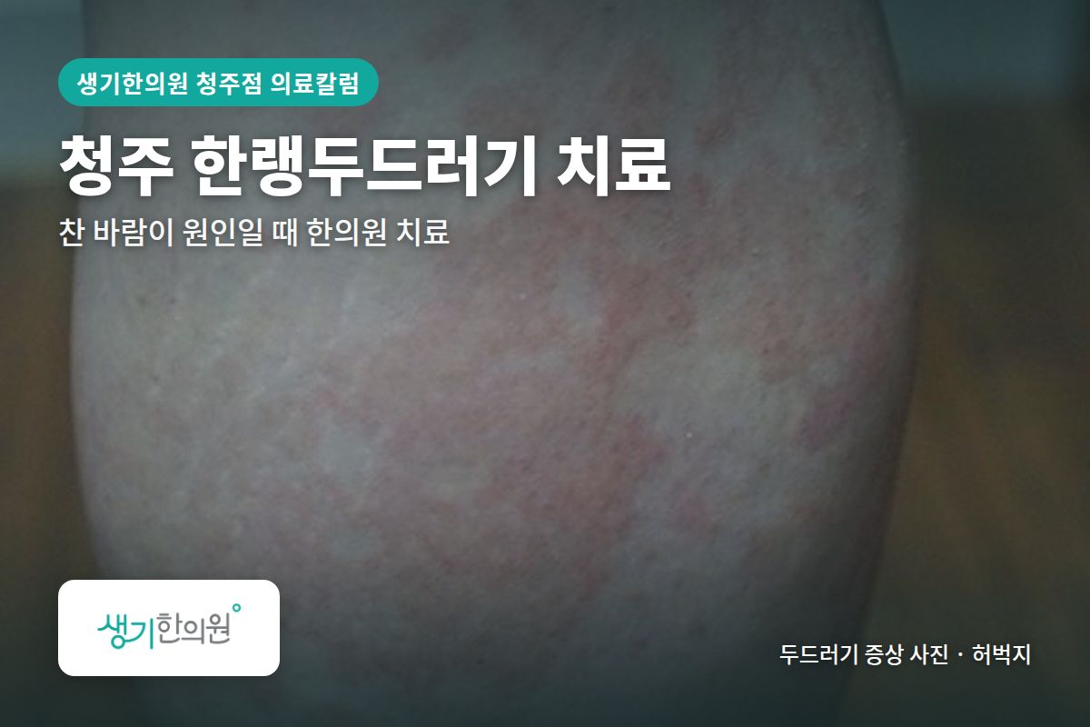 허벅지 한랭두드러기 증상 사진과 문구 「청주 한랭두드러기 치료, 찬 바람이 원인일 때 한의원 치료 · 생기한의원 청주점」