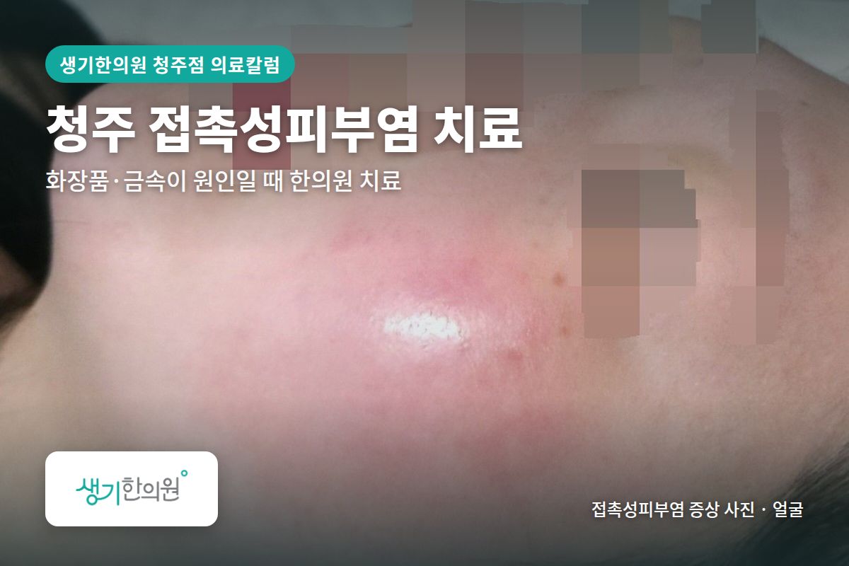 얼굴 접촉성피부염 증상 사진과 문구 「청주 접촉성피부염 치료, 화장품·금속이 원인일 때 한의원 치료 · 생기한의원 청주점」