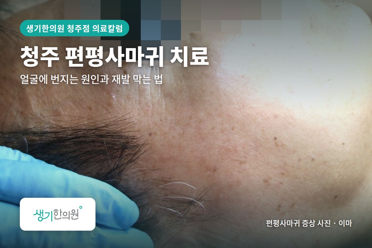 이마 편평사마귀 증상 사진과 문구 「청주 편평사마귀 치료, 얼굴에 번지는 원인과 재발 막는 법 · 생기한의원 청주점」