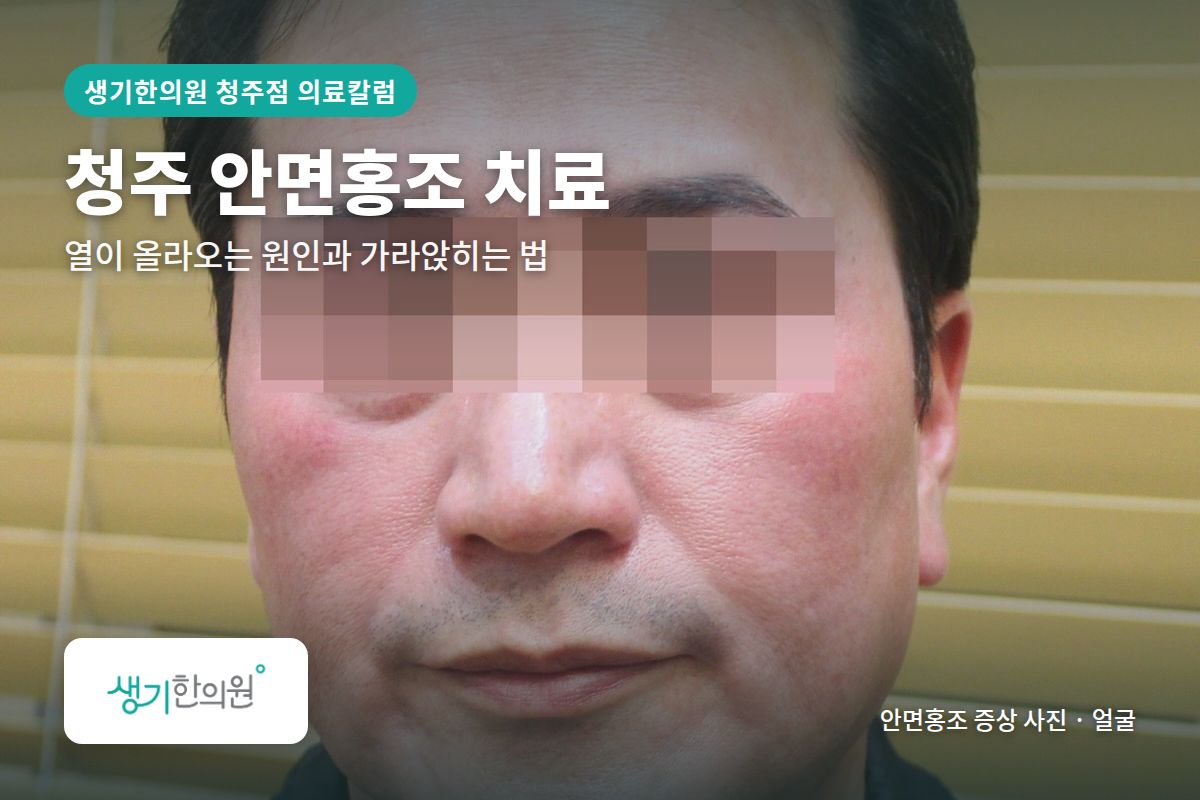 얼굴 안면홍조 증상 사진과 문구 「청주 안면홍조 치료, 열이 올라오는 원인과 가라앉히는 법 · 생기한의원 청주점」