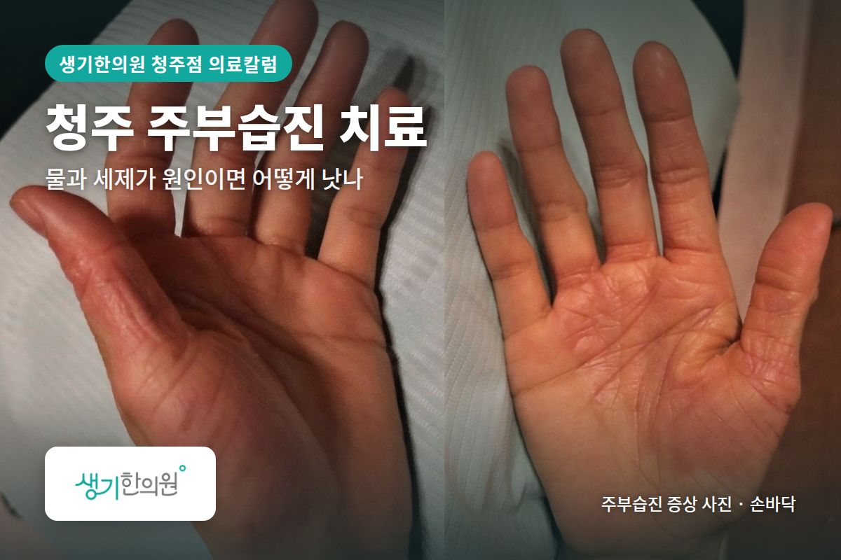 손바닥 주부습진 증상 사진과 문구 「청주 주부습진 치료, 물과 세제가 원인이면 어떻게 낫나 · 생기한의원 청주점」