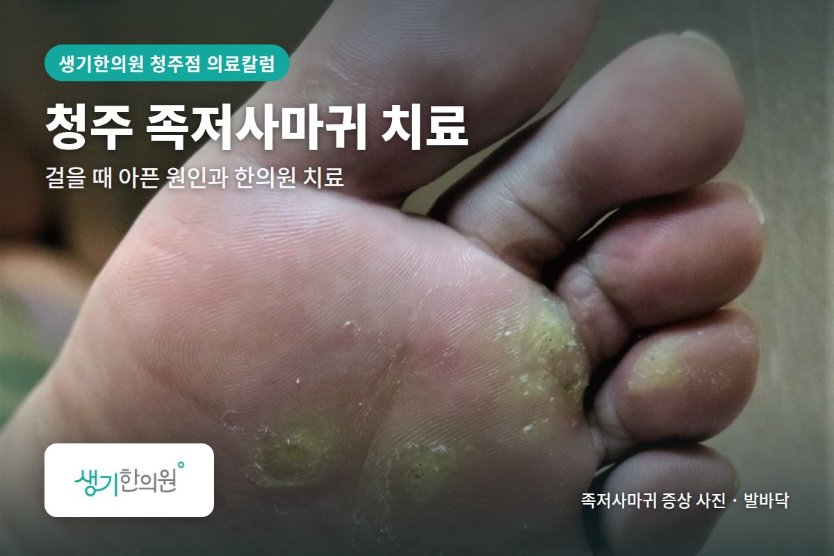 발바닥 족저사마귀 증상 사진과 문구 「청주 족저사마귀 치료, 걸을 때 아픈 원인과 한의원 치료 · 생기한의원 청주점」