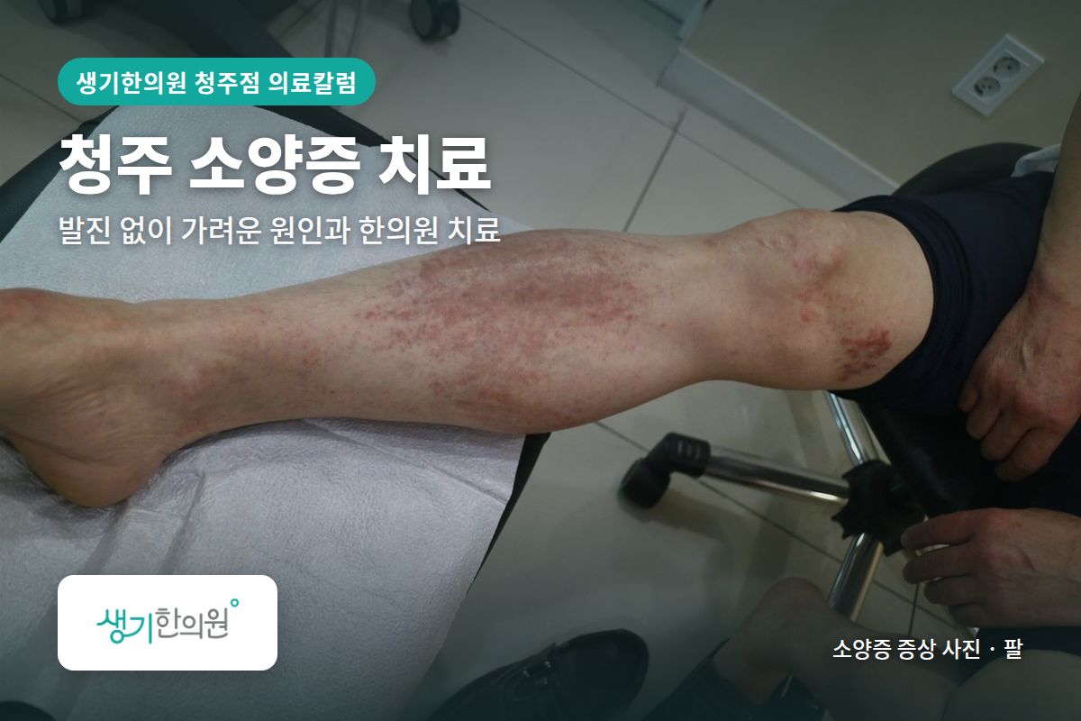 팔 소양증 증상 사진과 문구 「청주 소양증 치료, 발진 없이 가려운 원인과 한의원 치료 · 생기한의원 청주점」