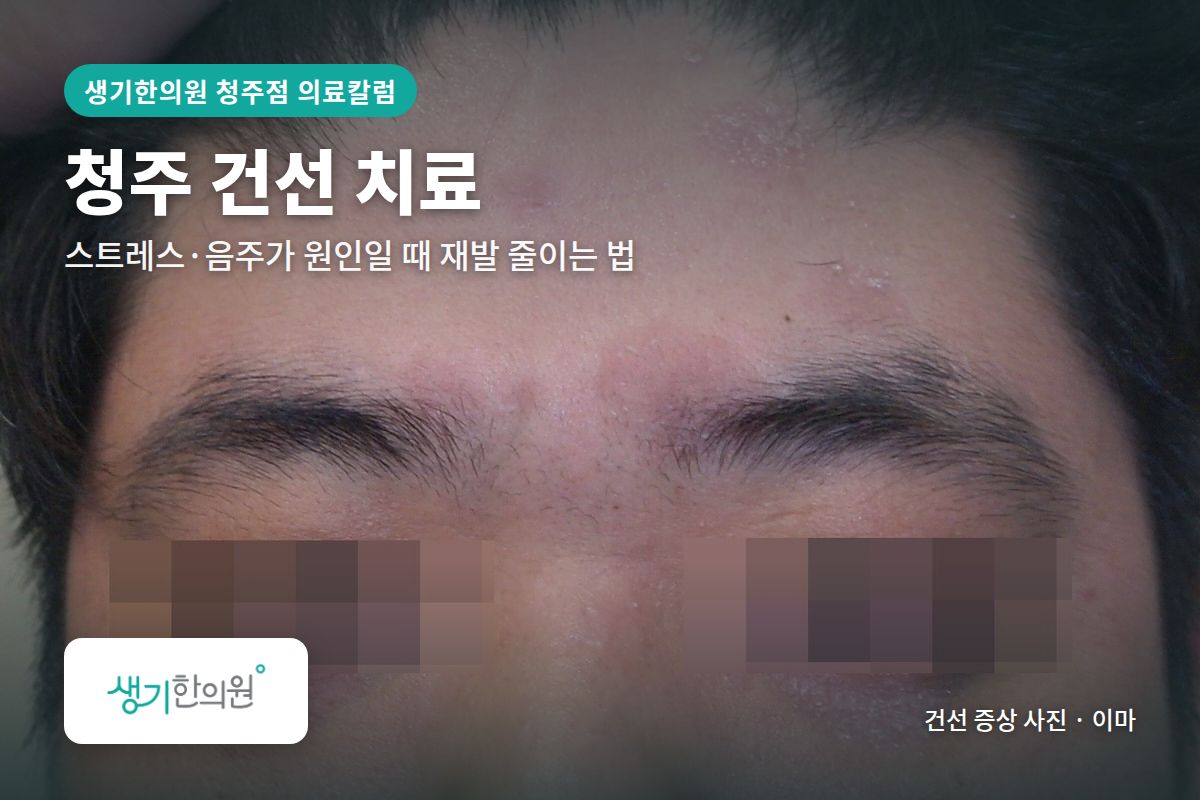 이마 건선 증상 사진과 문구 「청주 건선 치료, 스트레스·음주가 원인일 때 재발 줄이는 법 · 생기한의원 청주점」