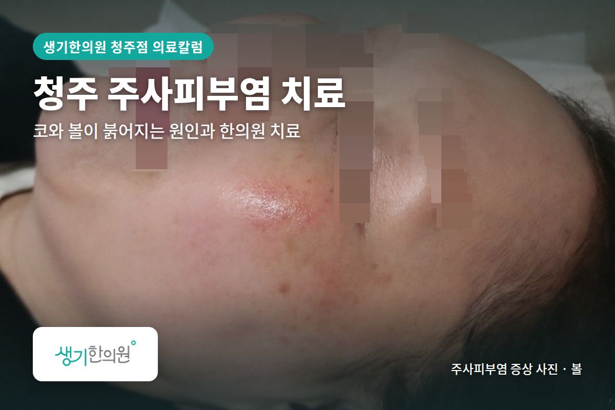 볼 주사피부염 증상 사진과 문구 「청주 주사피부염 치료, 코와 볼이 붉어지는 원인과 한의원 치료 · 생기한의원 청주점」