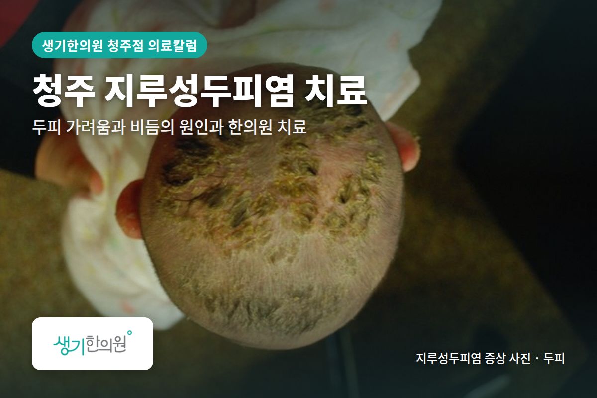 두피 지루성두피염 증상 사진과 문구 「청주 지루성두피염 치료, 두피 가려움과 비듬의 원인과 한의원 치료 · 생기한의원 청주점」
