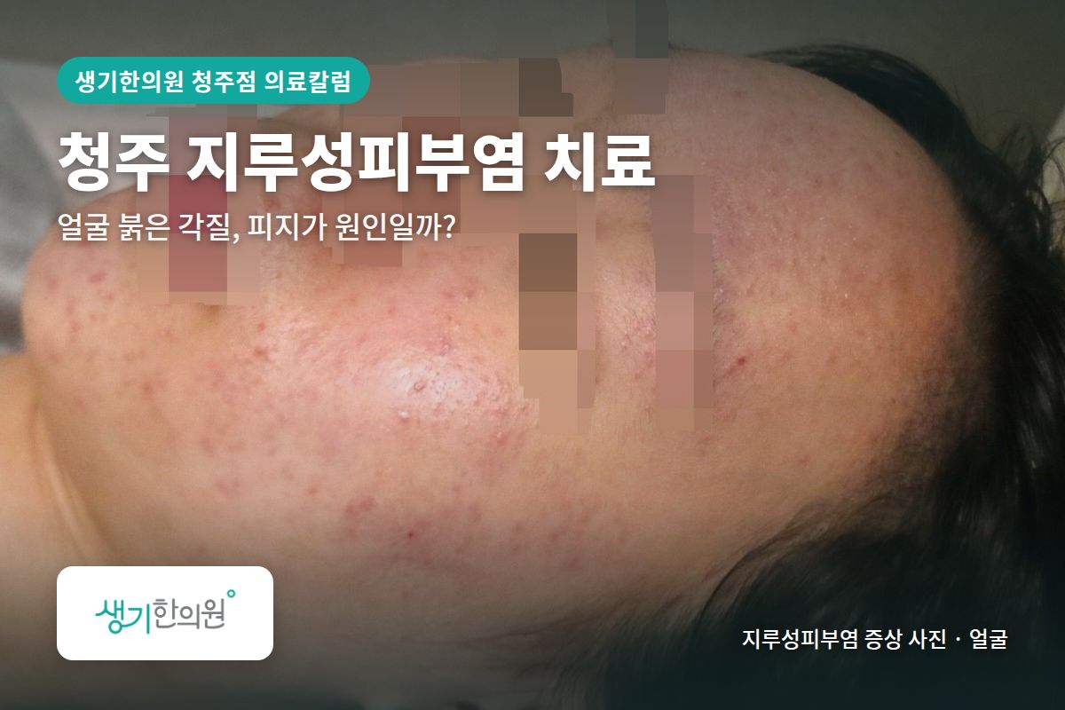 얼굴 지루성피부염 증상 사진과 문구 「청주 지루성피부염 치료, 얼굴 붉은 각질, 피지가 원인일까? · 생기한의원 청주점」