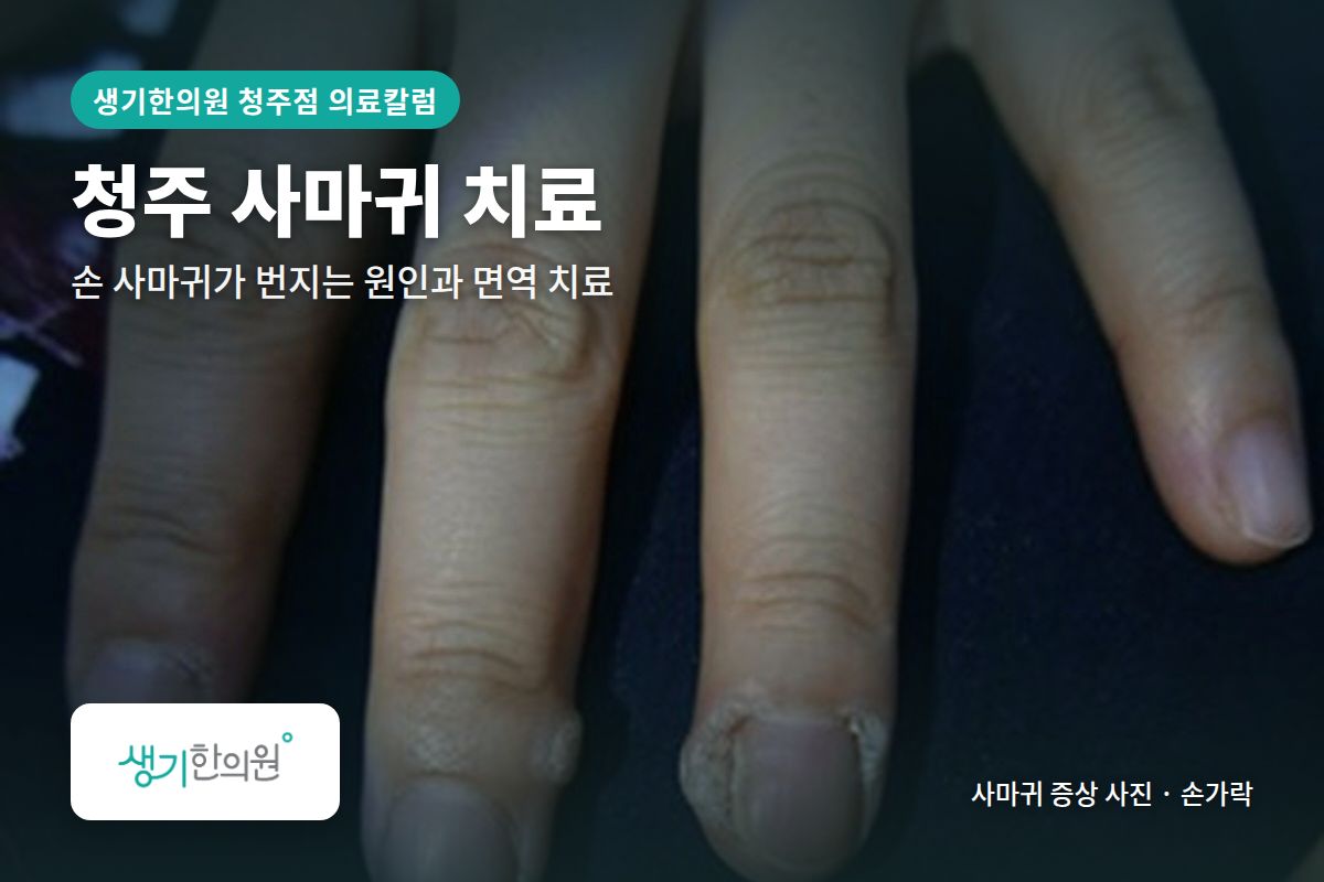 손가락 사마귀 증상 사진과 문구 「청주 사마귀 치료, 손 사마귀가 번지는 원인과 면역 치료 · 생기한의원 청주점」