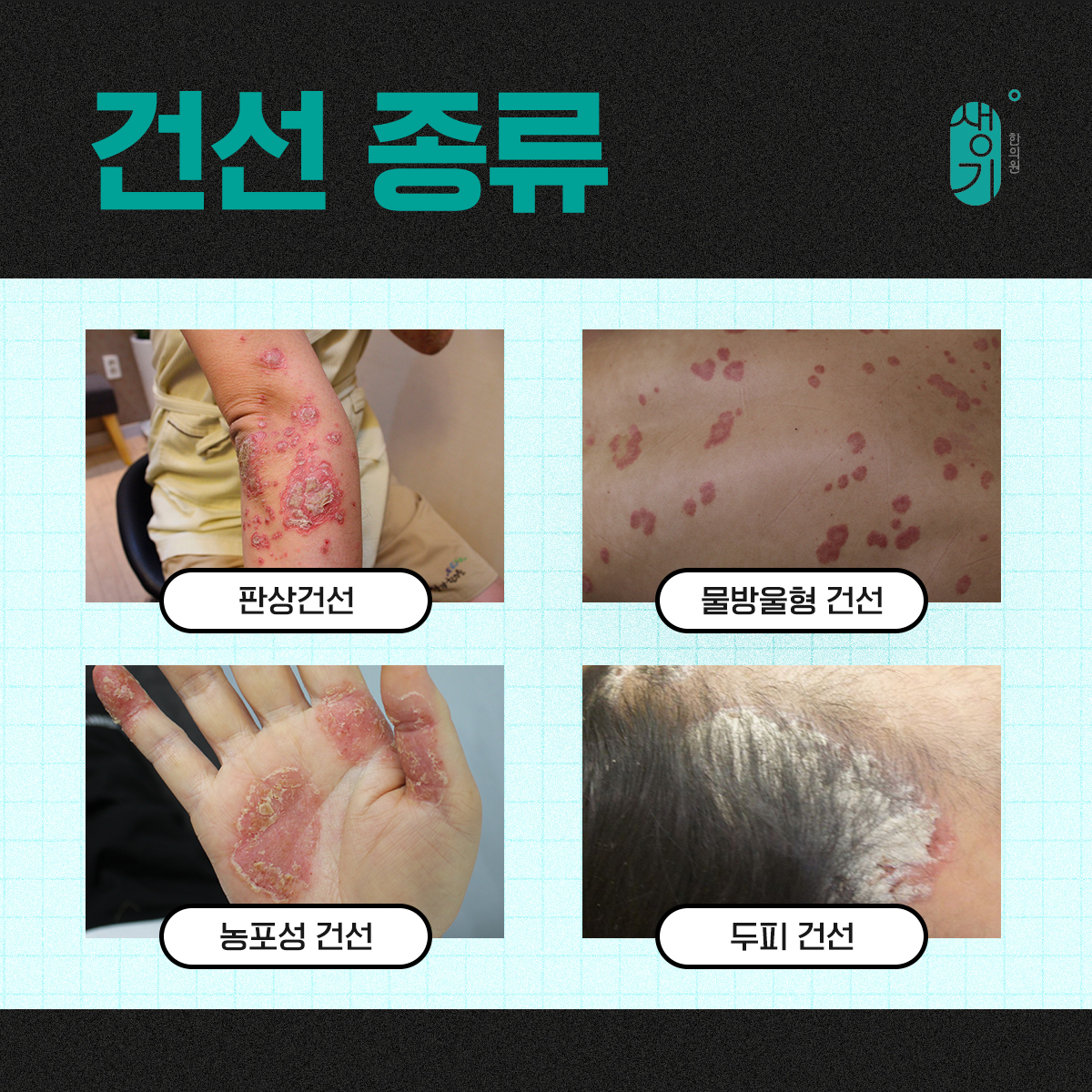 건선 종류별 사진 4장 — 판상건선, 물방울형 건선, 농포성 건선, 두피 건선