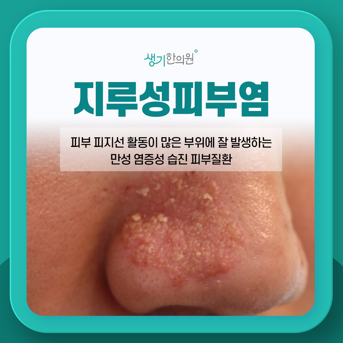 코 주변 지루성피부염 사진과 설명 「피부 피지선 활동이 많은 부위에 잘 발생하는 만성 염증성 습진 피부질환」