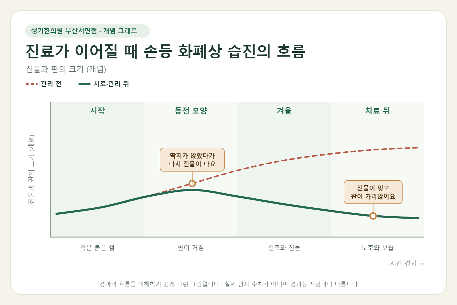 진료가 이어질 때 손등 화폐상 습진의 흐름과 치료 뒤 변화를 그린 개념 그래프