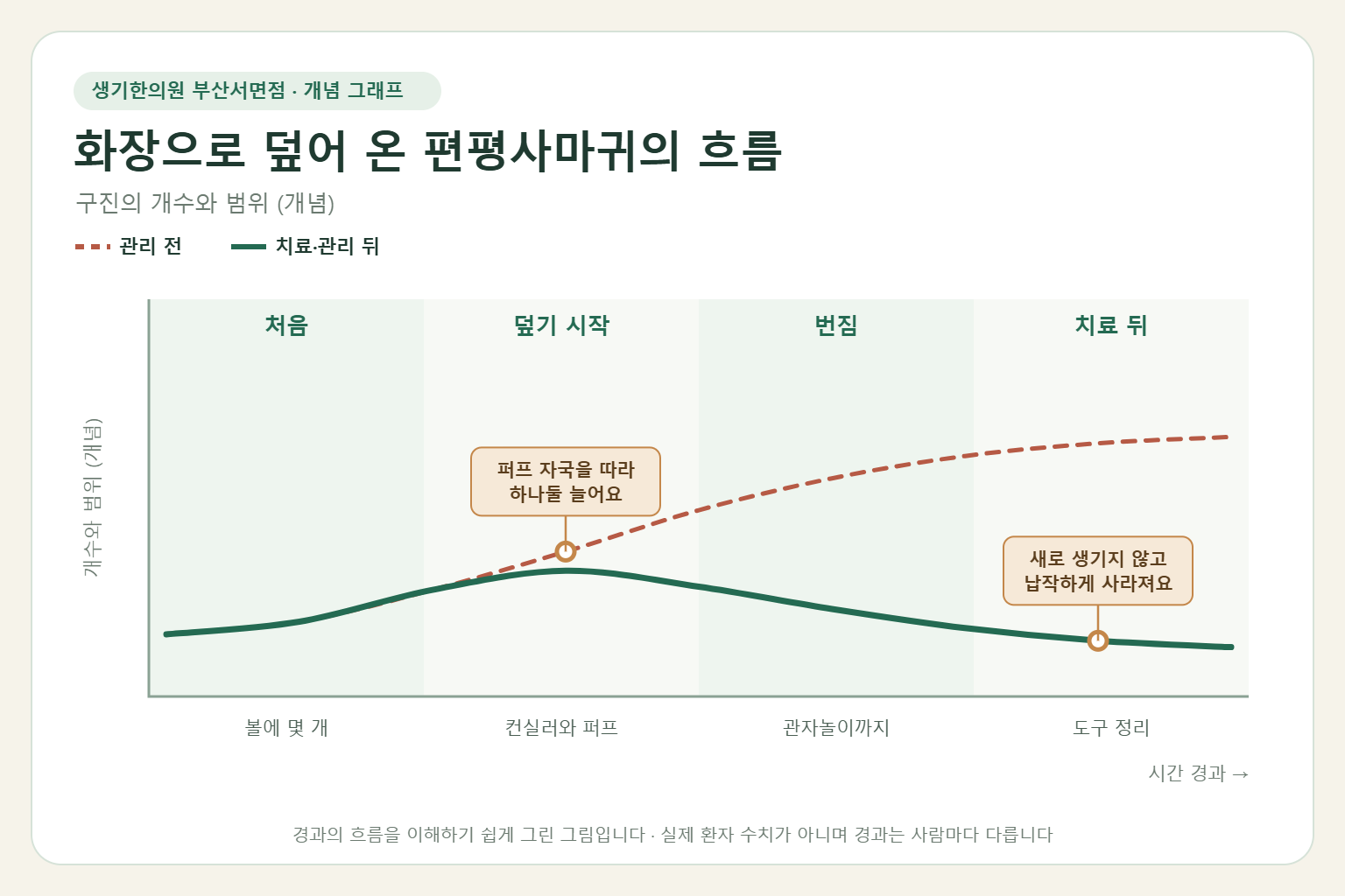 화장으로 덮어 온 편평사마귀의 흐름과 치료 뒤 변화를 그린 개념 그래프