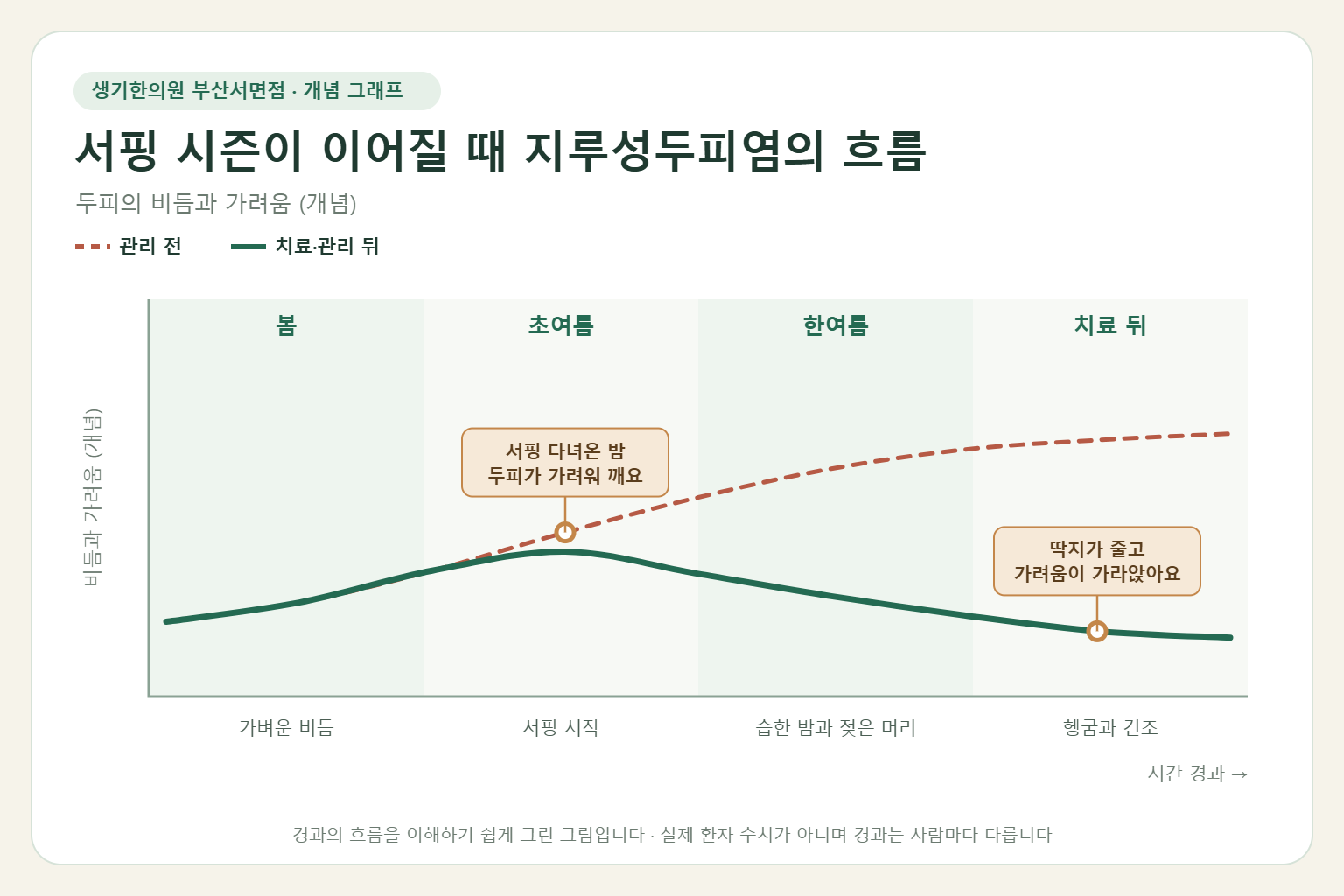 서핑 시즌이 이어질 때 지루성두피염의 흐름과 치료 뒤 변화를 그린 개념 그래프