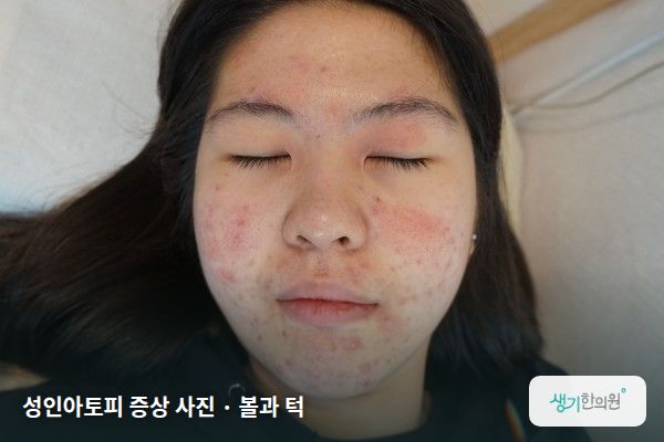 볼과 턱에 생긴 성인아토피 증상 사진 — 성인아토피 증상 사진 · 볼과 턱