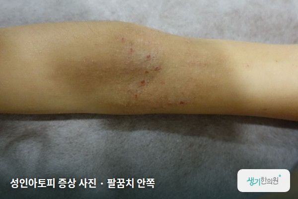 팔꿈치 안쪽에 생긴 성인아토피 증상 사진 — 성인아토피 증상 사진 · 팔꿈치 안쪽