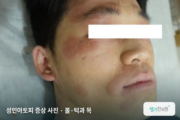 볼·턱과 목에 생긴 성인아토피 증상 사진 — 성인아토피 증상 사진 · 볼·턱과 목