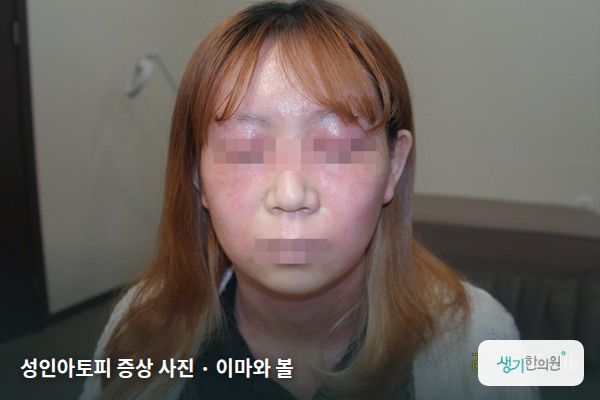 이마와 볼에 생긴 성인아토피 증상 사진 — 성인아토피 증상 사진 · 이마와 볼