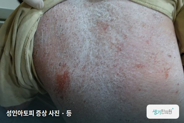 등에 생긴 성인아토피 증상 사진 — 성인아토피 증상 사진 · 등