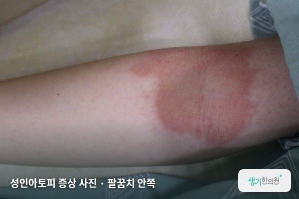 팔꿈치 안쪽에 생긴 성인아토피 증상 사진 — 성인아토피 증상 사진 · 팔꿈치 안쪽