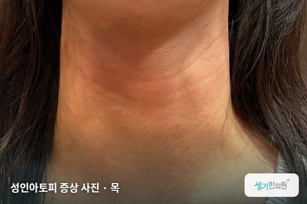 목에 생긴 성인아토피 증상 사진 — 성인아토피 증상 사진 · 목