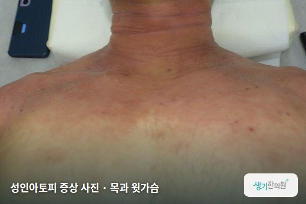 목과 윗가슴에 생긴 성인아토피 증상 사진 — 성인아토피 증상 사진 · 목과 윗가슴