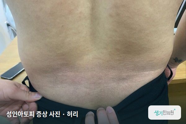 허리에 생긴 성인아토피 증상 사진 — 성인아토피 증상 사진 · 허리