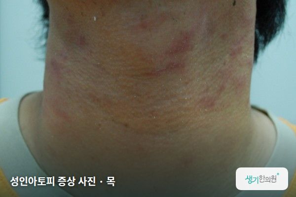 목에 생긴 성인아토피 증상 사진 — 성인아토피 증상 사진 · 목