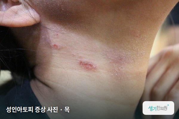 목에 생긴 성인아토피 증상 사진 — 성인아토피 증상 사진 · 목