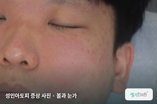 볼과 눈가에 생긴 성인아토피 증상 사진 — 성인아토피 증상 사진 · 볼과 눈가