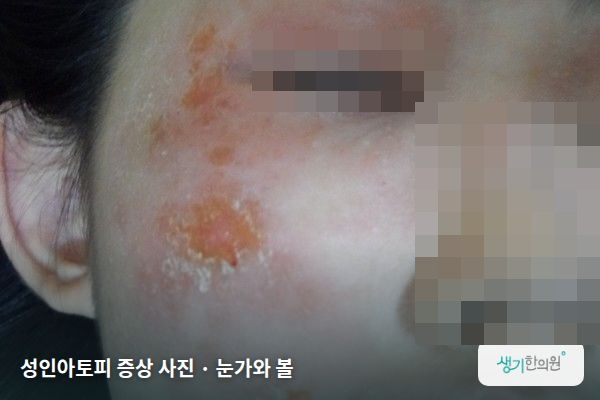 눈가와 볼에 생긴 성인아토피 증상 사진 — 성인아토피 증상 사진 · 눈가와 볼