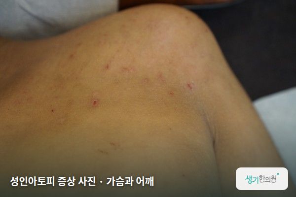 가슴과 어깨에 생긴 성인아토피 증상 사진 — 성인아토피 증상 사진 · 가슴과 어깨