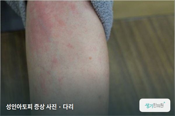 다리에 생긴 성인아토피 증상 사진 — 성인아토피 증상 사진 · 다리