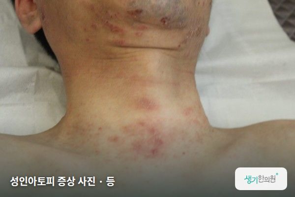 등에 생긴 성인아토피 증상 사진